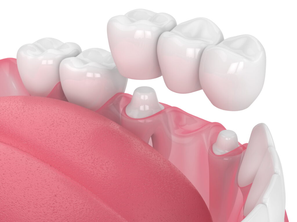 Dental bridges