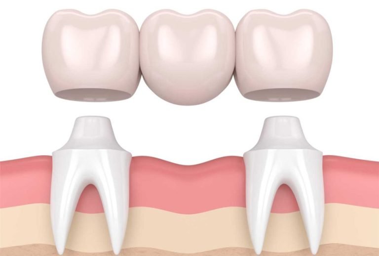 dental bridge abutment