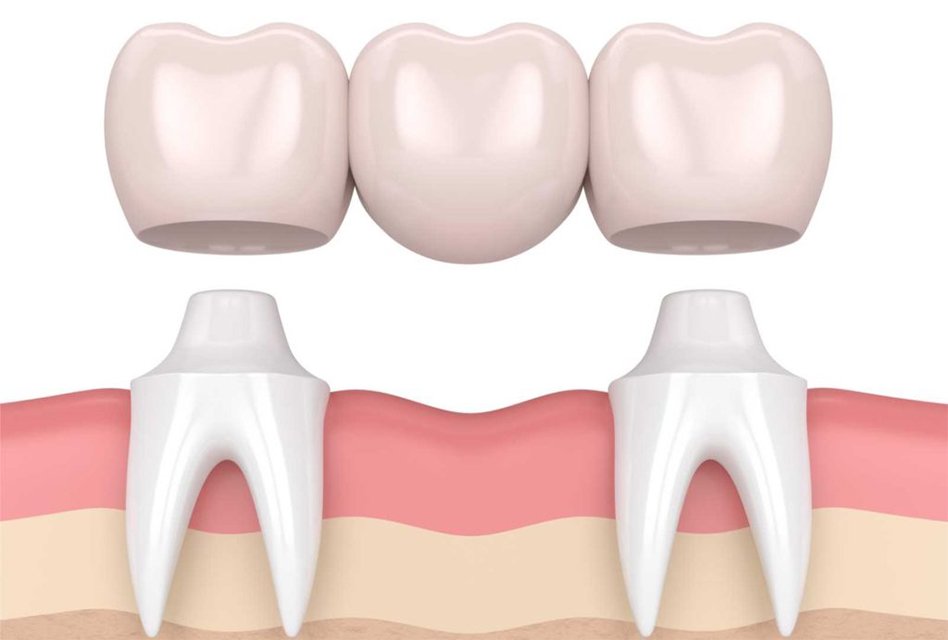 Dental Crowns