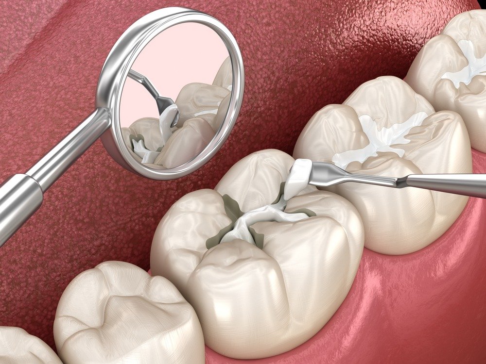 tooth cavity filling