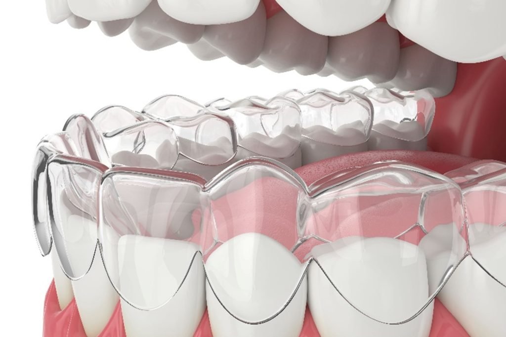 invisible aligners for teeth